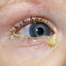 Common Eye Conditions & Diseases
