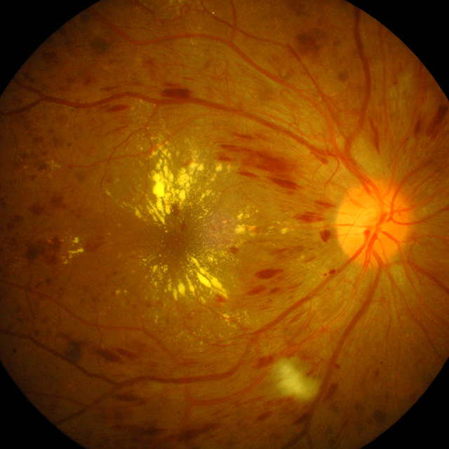 Diabetic Retinopathy