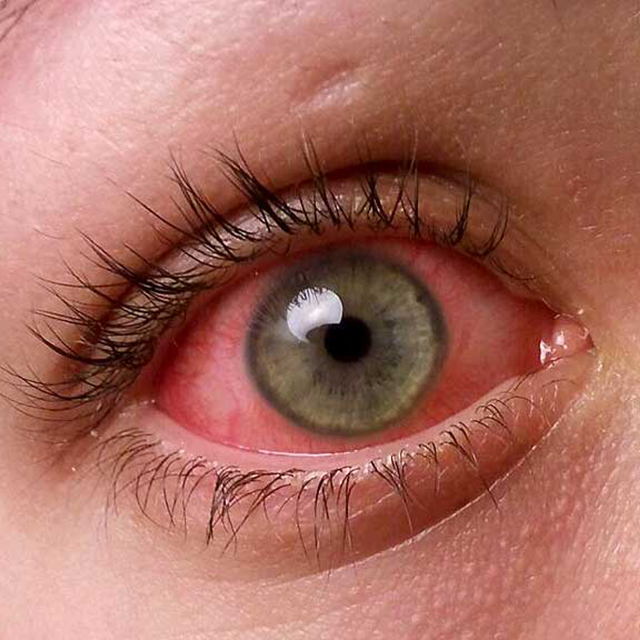 Conjunctivitis Pink Eye